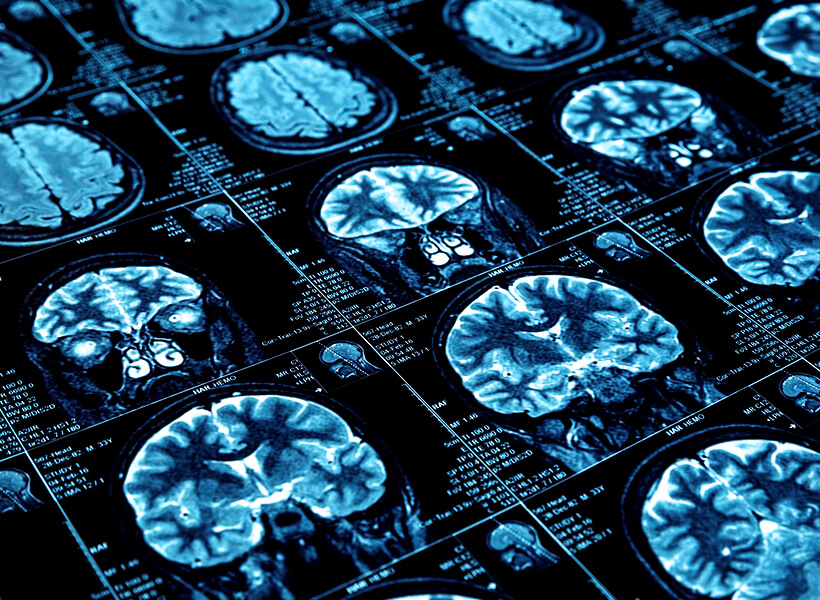 認知症リスク検査